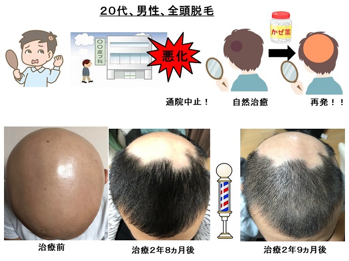 円形脱毛症　病院